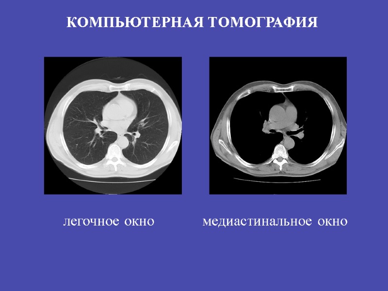 КОМПЬЮТЕРНАЯ ТОМОГРАФИЯ легочное окно  медиастинальное окно